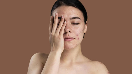 Acne and you, the ultimate survival guide